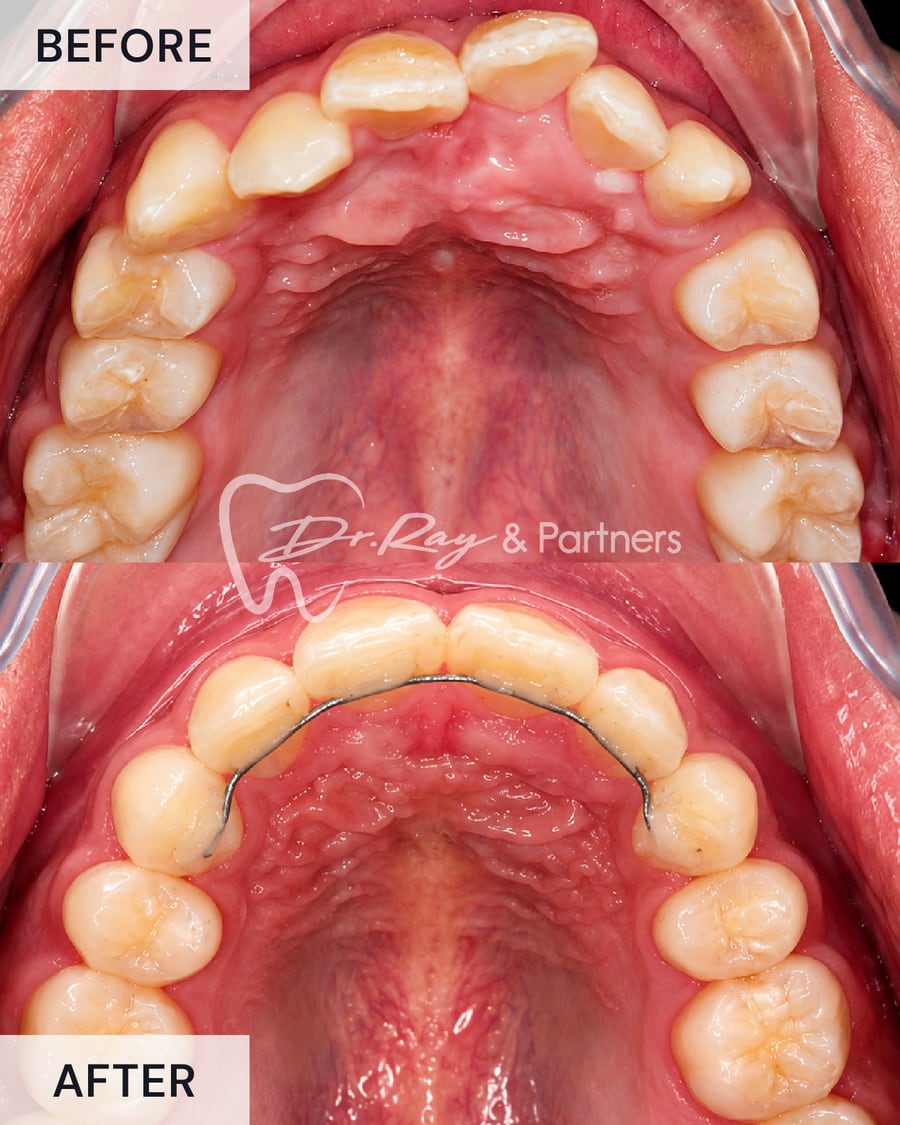 Before and after braces, upper teeth from above, crowding straightened at Dr Ray & Partners Dental