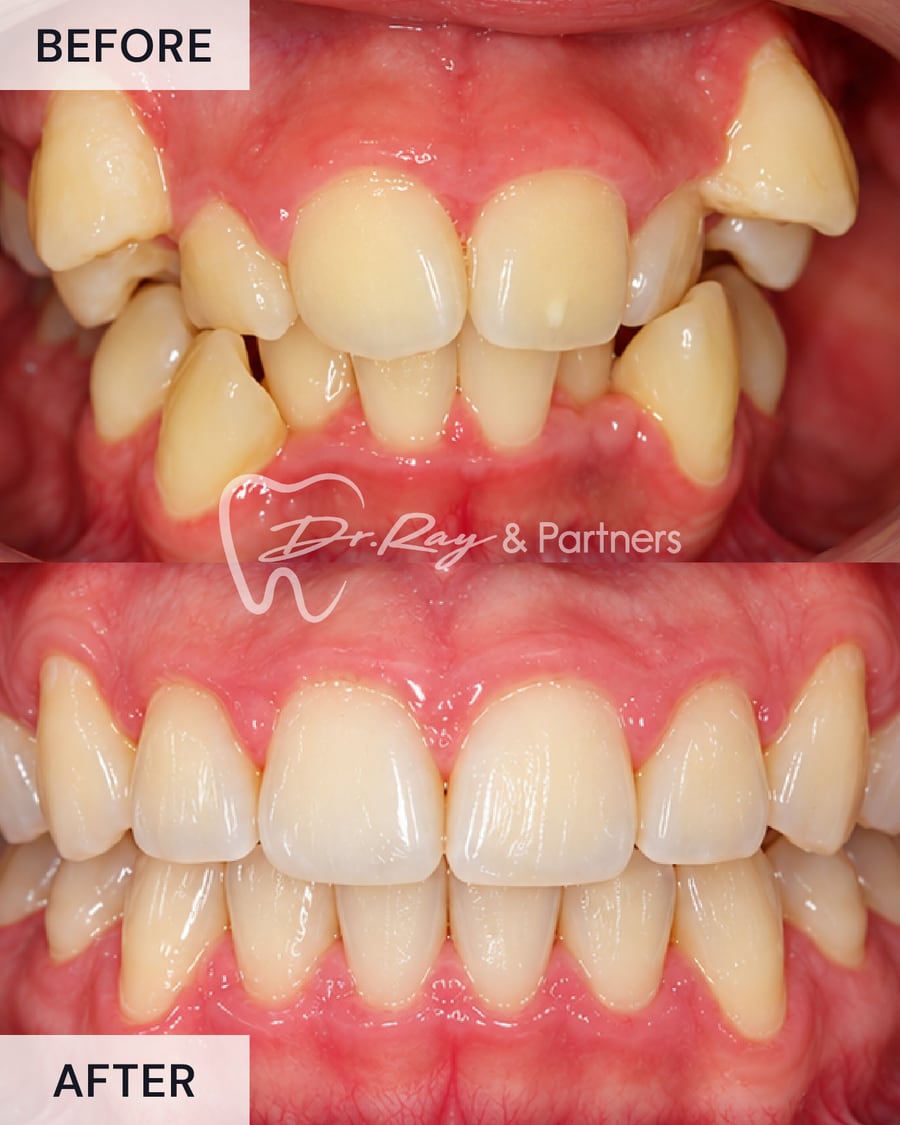 Before and after braces, front view, crowded teeth straightened at Dr Ray & Partners Dental