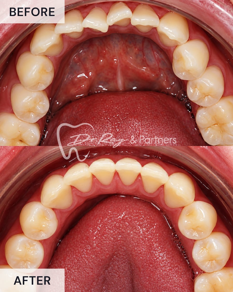 Before and after braces, lower teeth from above, crowding straightened at Dr Ray & Partners Dental