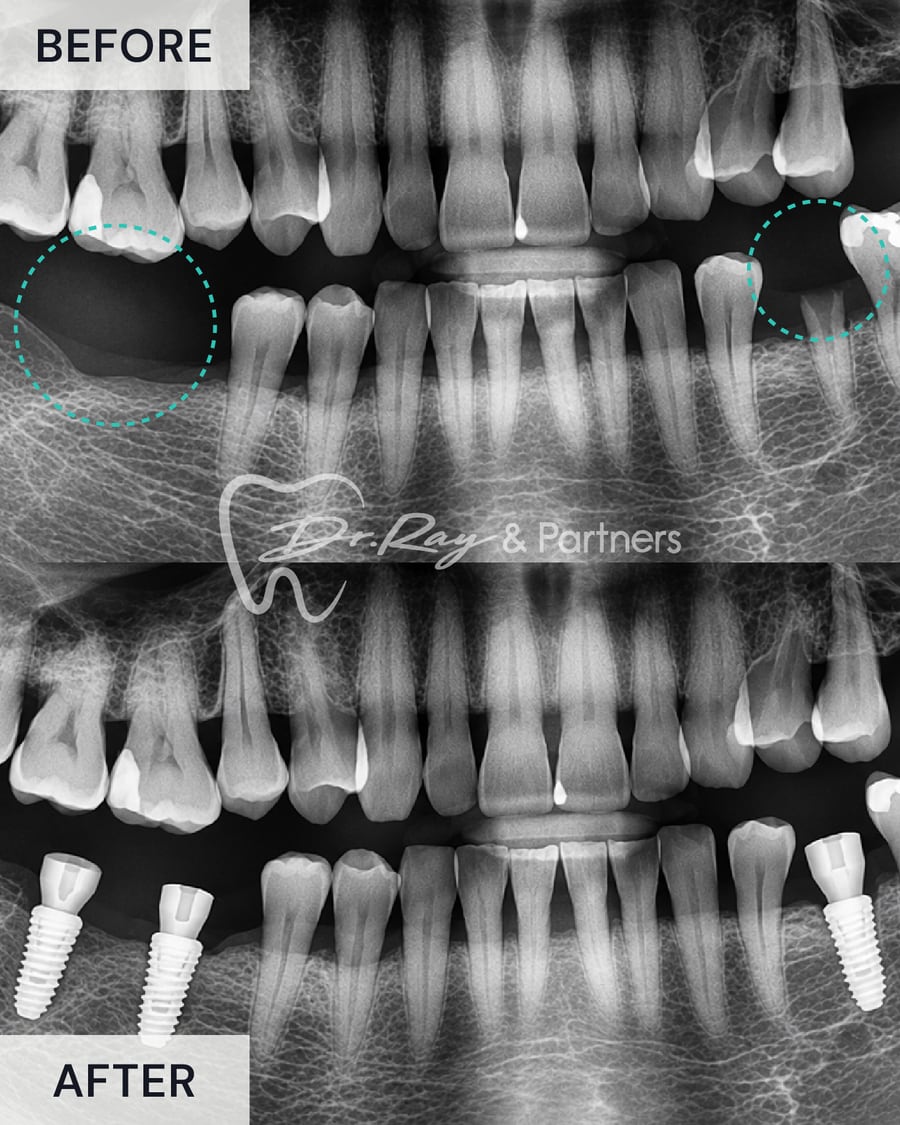 X-ray before and after two dental implants replacing missing lower back teeth at Dr Ray & Partners Dental