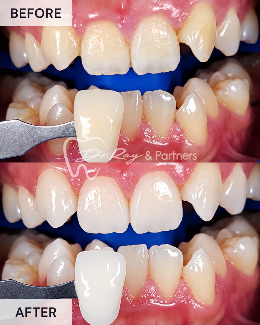 Before and after teeth whitening, compared against a shade guide at Dr Ray & Partners Dental, case 3